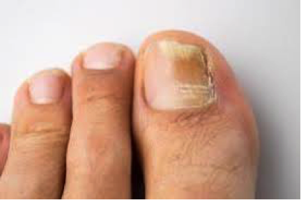 ONMICOSIS