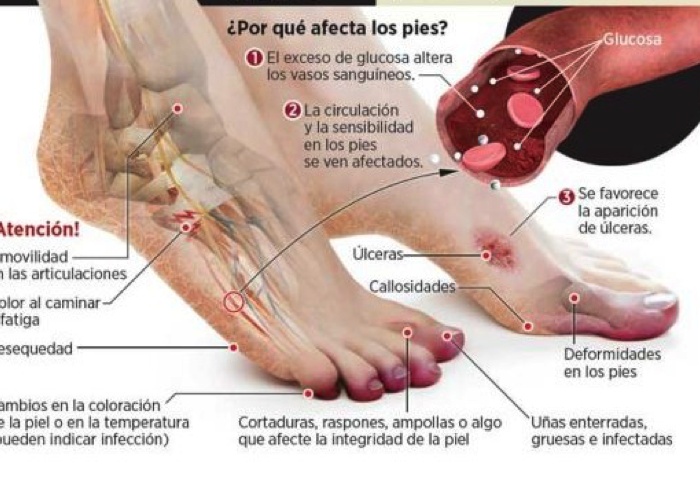 piediabetico